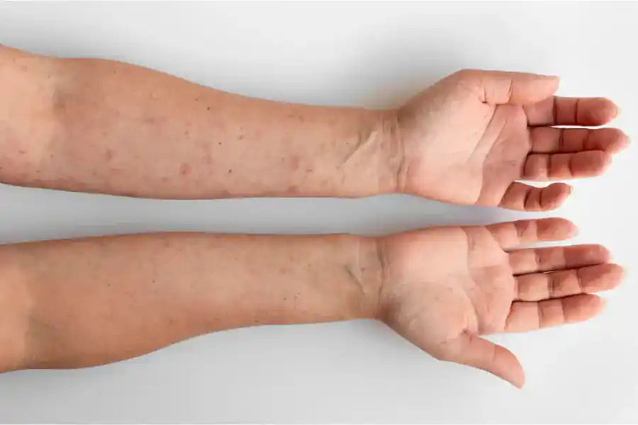 Jeuk en Irritatie? Sea Moss als Eczeem Oplossing