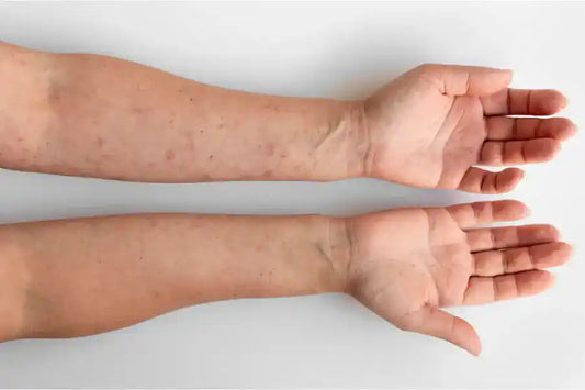 Jeuk en Irritatie? Sea Moss als Eczeem Oplossing
